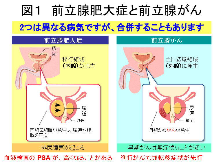 前立腺がんの診断 | 大阪腎泌尿器疾患研究財団